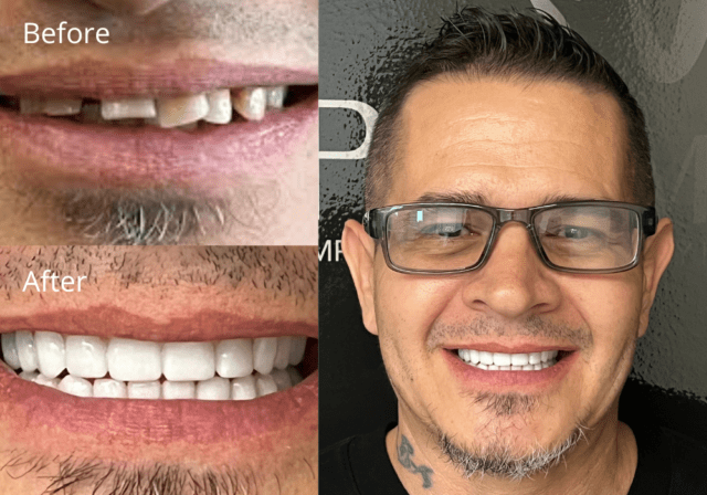Dental Implant Results at ProSmile Dental Implant Center