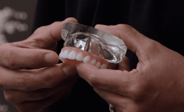 model of all on 4 dental implants